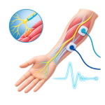 EMG nerve